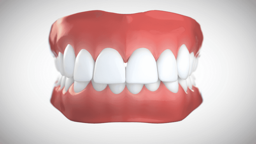 Supraclusion incisive (morsure profonde)