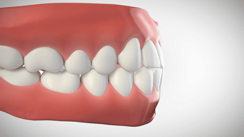 Articulé incisif bout-à-bout
