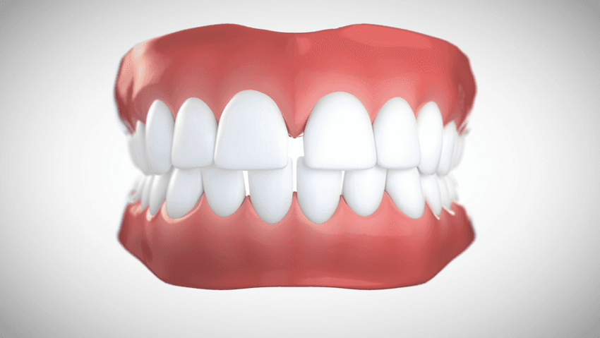 Diastèmes (espacement dentaire)